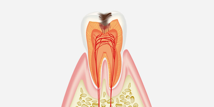 C2：冷たい物がしみる・痛みを感じる虫歯