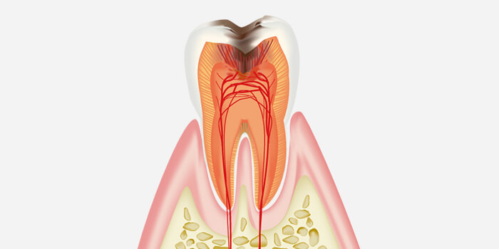 C3：神経にまで達し、激しい痛みを感じる大きな虫歯