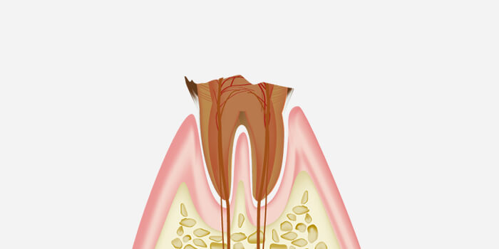 C4：歯の根だけが残った末期の虫歯